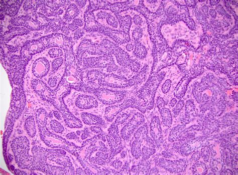 Basal Cell Adenoma Histology