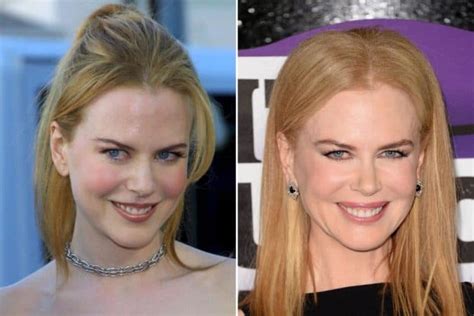 Nicole Kidman Plastic Surgery Before And After Photos