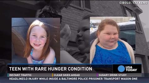 Rare Condition Caused Teen To Gain 150 Pounds