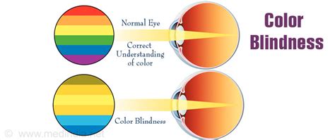 Color Blindness Types Causes Symptoms Diagnosis And Treatment
