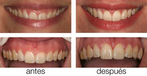 Cirugía Estética Periodontal De Encía Clínica Sada Blog