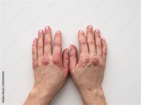 Psoriasis Skin Closeup Of Rash And Scaling On The Patients Skin The