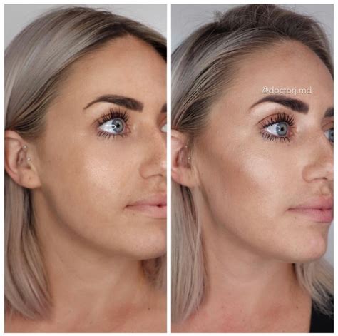 With cheek fillers, hollow gaunt cheeks are a thing of the past. My Experience With Dermal Fillers. | allypintucci.com