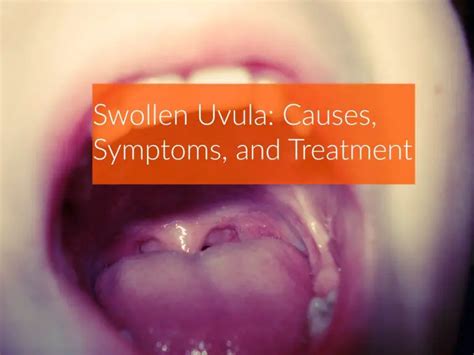 Swollen Uvula Causes Symptoms And Treatment The Healthy Apron
