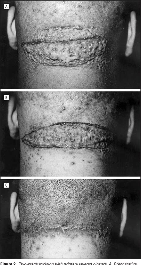 Figure From The Surgical Management Of Extensive Cases Of Acne Keloidalis Nuchae Semantic