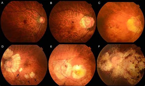 Management Of High Myopia Insight