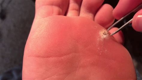Day 53 Plantar Wart Removal Update Digging Out The Middle Again