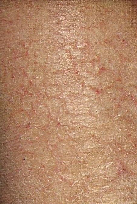 Eczema Craquele