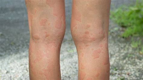 Chronic Hives Can Be Triggered By The Same Causes As Acute Cases Of