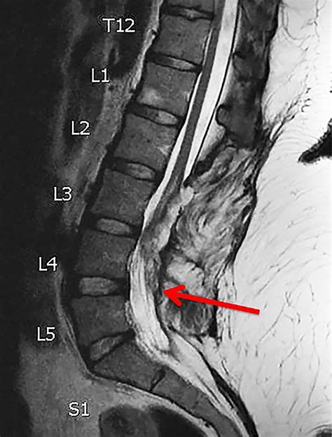 Tethered Spinal Cord Syndrome Pictures