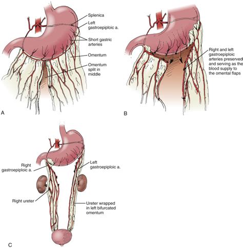 Ureteral Stricture Repair And Ureterolysis Abdominal Key