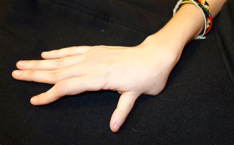 Thumb Deformity Congenital Hand And Arm Differences