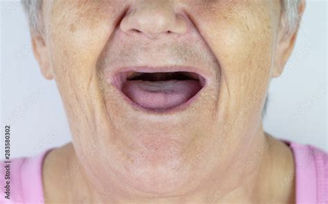 Toothless Mouth An Elderly Woman With No Teeth Old Granny With Her Mouth Open Stock Foto