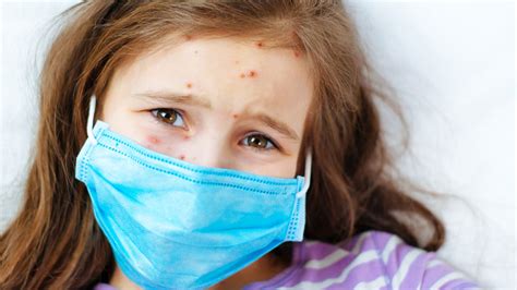 What Parents Need To Know About The Measles Outbreak
