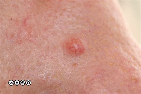 Mimics Of Skin Cancer I Skin Cancer 909