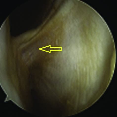 Arthroscopic View Of The Lateral Gutter Of The Left Knee In Extension