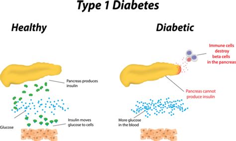 Imcyses Type 1 Diabetes Immunotherapy Shows Promise In Phase I