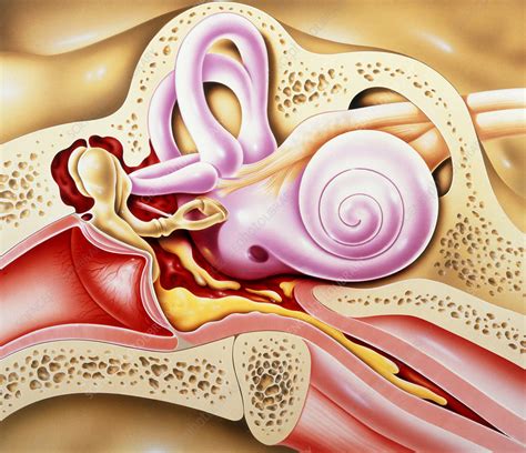 otitis media of ear stock image m157 0029 science photo library
