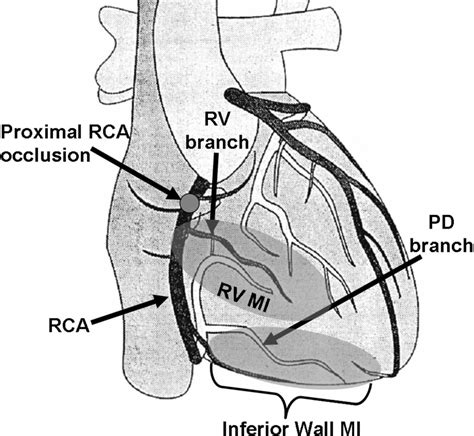 The Right Coronary Artery Rca Supplies Blood To The Inferior Wall Of
