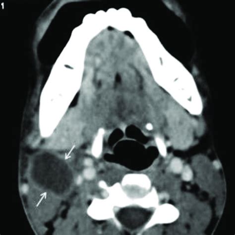 Beak Sign In Second Branchial Cleft Cyst Contrast Enhanced Ct Image