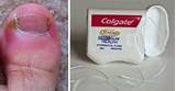 Images of Big Toenail Infection Home Remedies