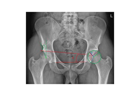 Do Acetabular Parameters Measured On 2d Imaging Correlate With Ct And