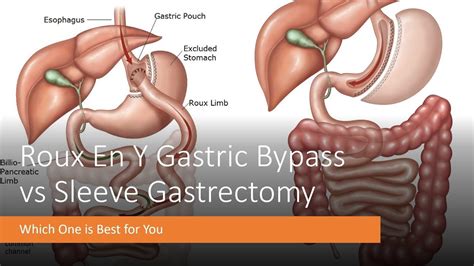 Roux En Y Gastric Bypass Vs Sleeve Gastrectomy Which One Is Best For