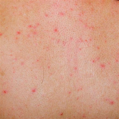 Red Itchy Bumps 10 Common Causes Treatments Self