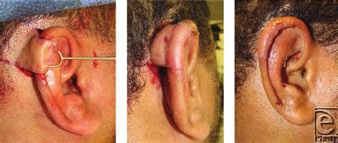 Intraoperative Transposition Of A Superiorly Based Postauricular
