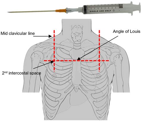 Needle Thoracocentesis