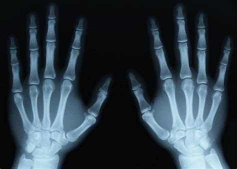 Rheumatoid Arthritis X Ray Rebecca Bond