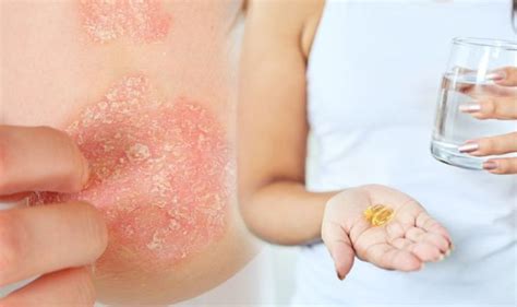 Eczema Treatment Natural Vitamin To Help Ease Painful Rash Like