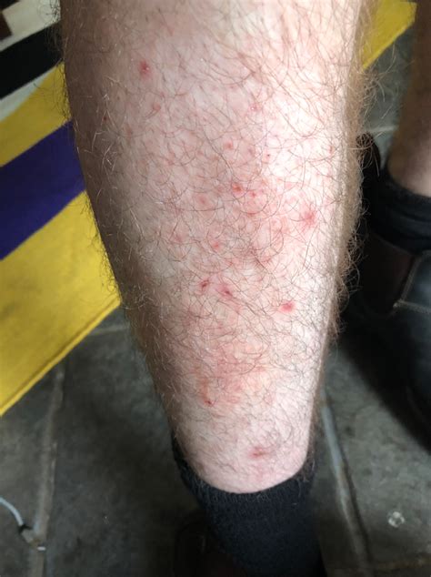 Ive Had This Itchy Rash On My Leg For Almost A Month I Moisturize It