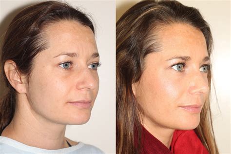 Before And After Open Rhinoplasty Plastic Surgery