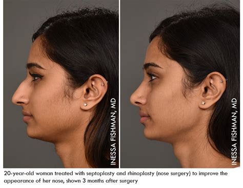 Surgical Repair Of The Nose
