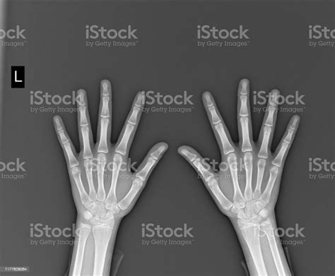 Film Xray Both Hand Ap Show Normal Humans Hands On Black Background