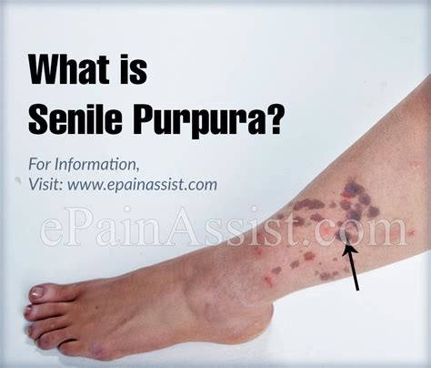 What Is Senile Purpura And How Is It Treatedcauses Symptoms Natural