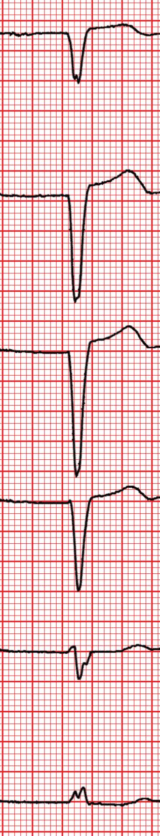 Cardio FR Left Atrial Rhythm First Degree A V Block LBBBB Long QT