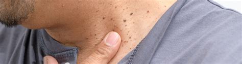 Common Skin Growths Vitalskin Dermatology