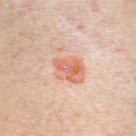 Leg Early Stage Squamous Cell Skin Cancer Pictures Steve
