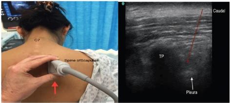 Ultrasound Guided Paravertebral Block Wfsa Resources
