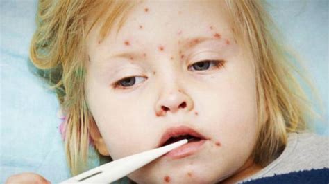 Video Measles Outbreak 84 Cases Across 14 States Abc News