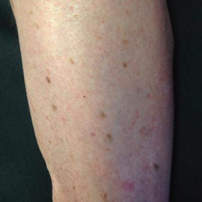 Topical Chemotherapy For Numerous Superficial Basal Cell Carcinomas Years After Isolated Limb