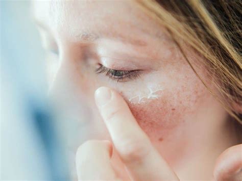 White Patches On Face Spots Reasons Causes Get Rid Treatment