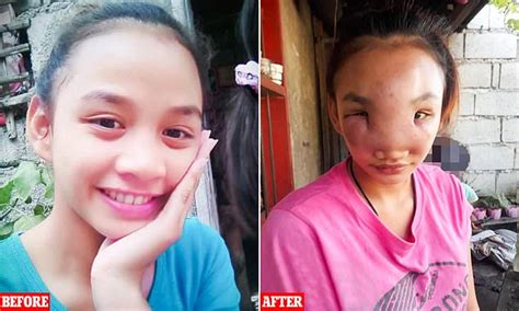 Teenage Mother Left With Huge Facial Swelling After Squeezing A Spot On
