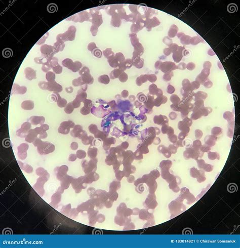 Yeast Cells Phagocytosis By White Blood Cell In Blood Smearfungus Blood