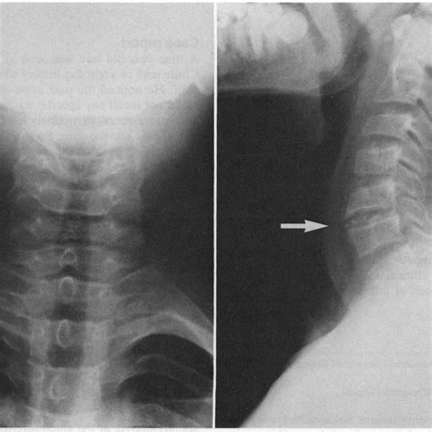 Ct Scan Of The Mid And Lower Cervical Spine Shows The Intervertebral