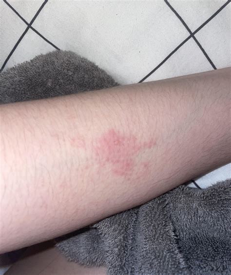 One Blister On Arm Surrounded By Very Itchy Redness More Info In Text