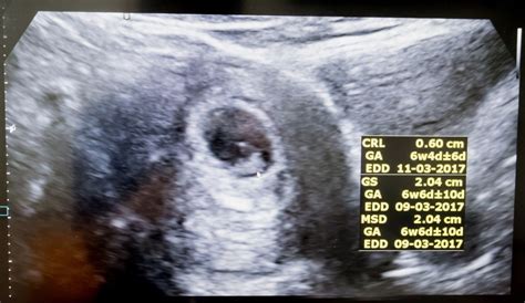 Is A Fetal Heartbeat Really A Heartbeat At 6 Weeks Verve Times