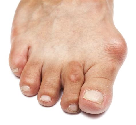 Hammer Toes Deformity Of The Lesser Toe